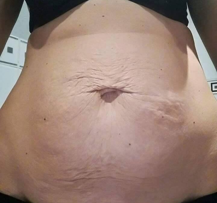 Most Effective Ways to Overcome Stretch Marks Naturally
