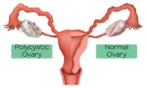 Poly Cystic Ovary Syndrome – PCOS